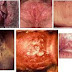 Penyebab luka pada Vagina atau Penis