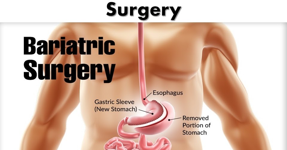All You Need To Know About Lap Band Surgery