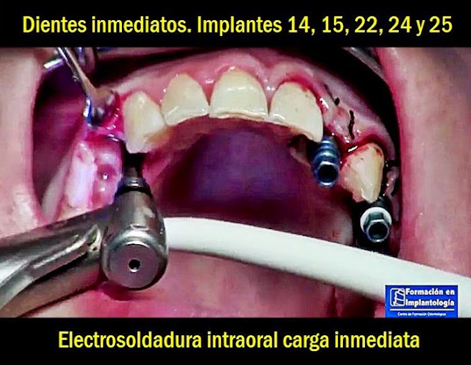 IMPLANTES INMEDIATOS: Electrosoldadura intraoral, Carga inmediata - Dr. Ismael Soriano