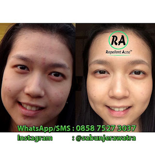 Sabun Jerawat Alami Sabun Jerawat Alami