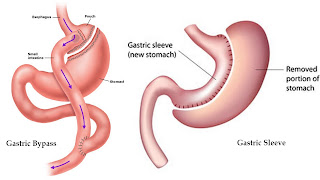 Sleeve gastrectomy