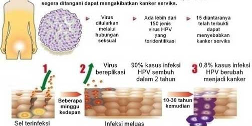 Faktor Infeksi Kanker Serviks dan Wanita Harus Berhati-Hati