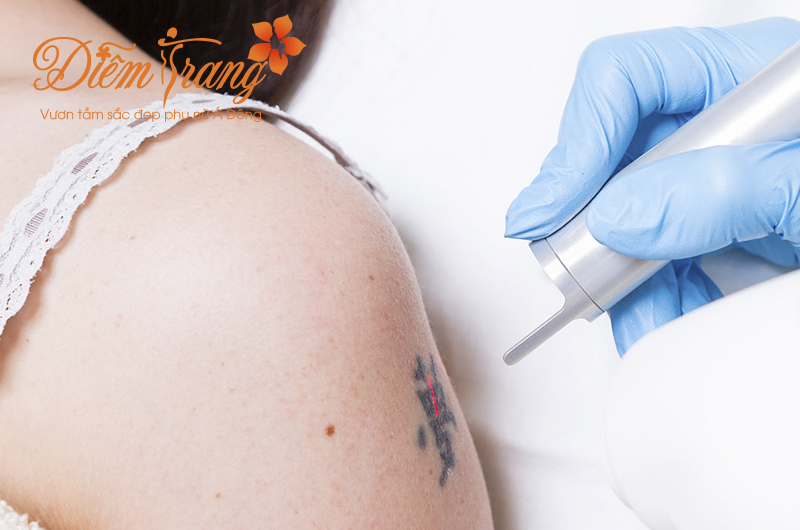 Xóa xăm laser bao nhiêu tiền tại Diễm Trang Xóa xăm laser bao nhiêu tiền tại Diễm Trang