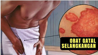 Obat Untuk Kulit Selangkangan Gatal Obat Untuk Kulit Selangkangan Gatal