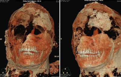 CAT scan reveals Pompeii victims had perfect teeth CAT scan reveals Pompeii victims had perfect teeth
