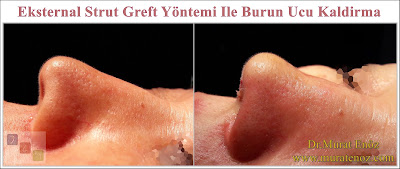 Nose tip drooping - Nose tip reshaping - Lifting the Nasal Tip - Technique of Nasal Tip Lifting - The External Strut Graft Technique- Nasal Tip Lifting - Nose Lift - Nose Lift Surgery - Lift Nose