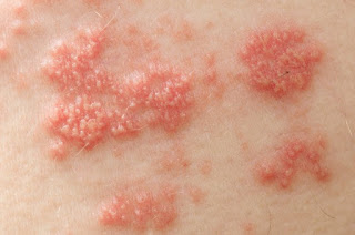 Como Quitar El Herpes Como Quitar El Herpes