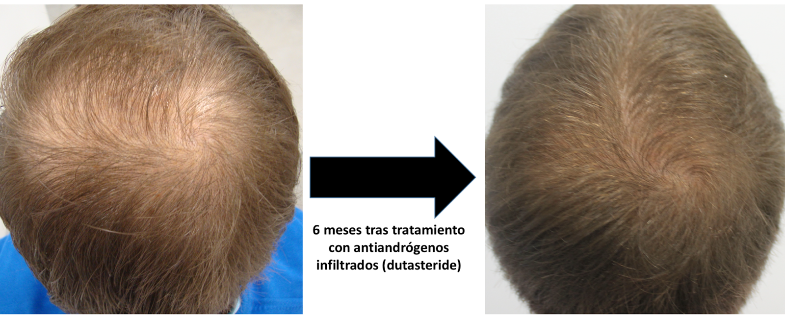 Alopecia Celulas Madre 2016 | dermatolog 237 a madrid expertos en alopecia y trasplante Alopecia Celulas Madre 2016 | dermatolog 237 a madrid expertos en alopecia y trasplante