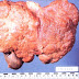 Manifestations and Features of chronic Liver cell failure Manifestations and Features of chronic Liver cell failure