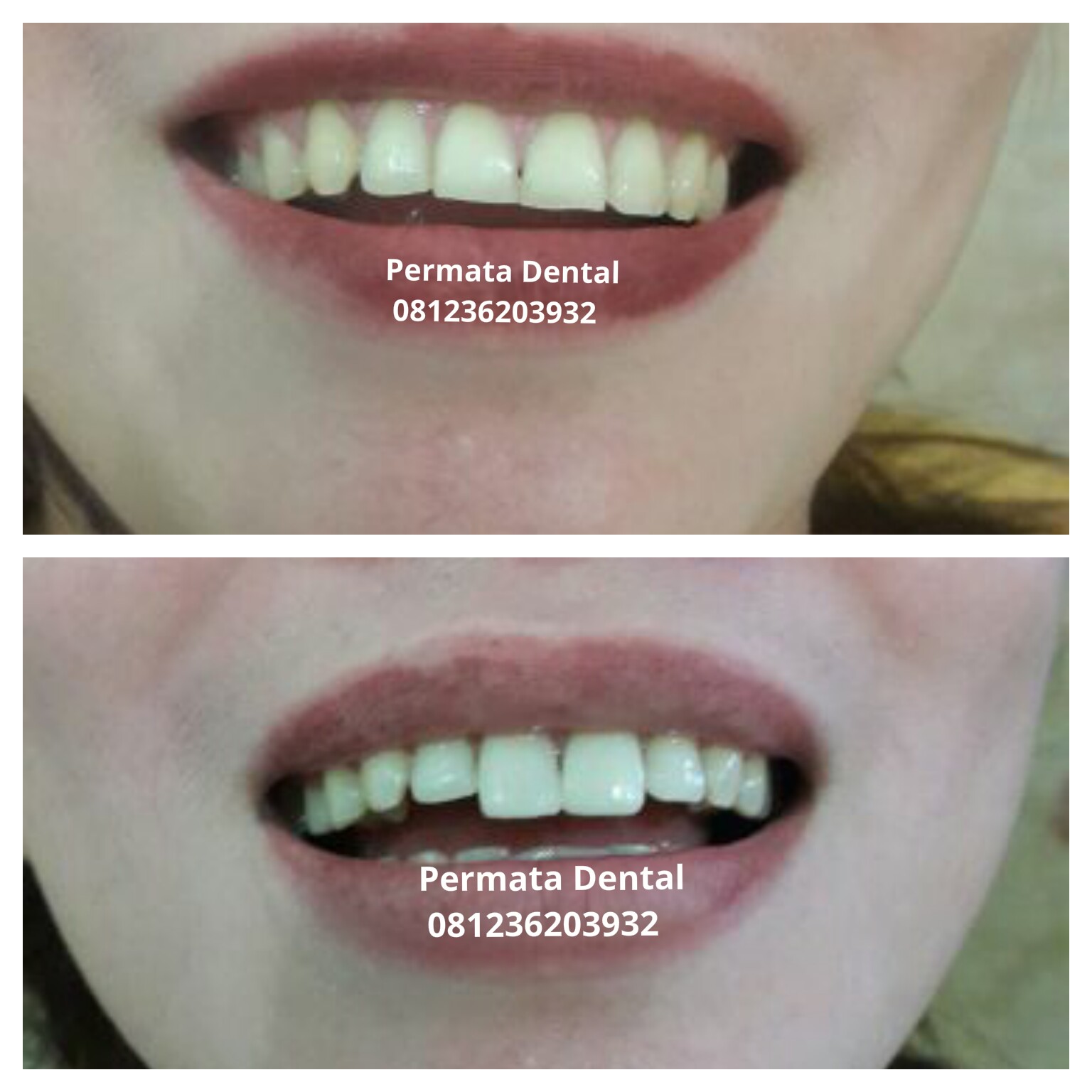 AHLI GIGI PALSU BALI PERMATA DENTAL : Veneer Gigi Kelinci Di Permata