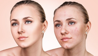 Scar Removal: Acne Treatment for the More Severe Cases Scar Removal: Acne Treatment for the More Severe Cases