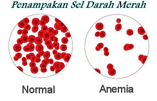 Cara Mengobati Anemia (Kurang Darah) Cara Mengobati Anemia (Kurang Darah)
