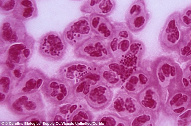Sex Superbug Drug Resistant Gonorrhea Could Rival Aids