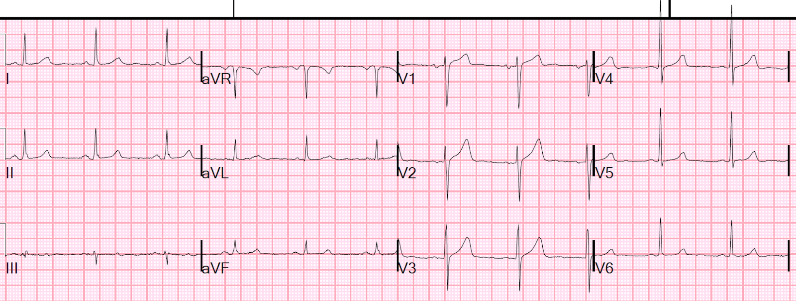 Dr. Smith's ECG Blog A Woman with 8 hours of Ongoing Crushing Chest