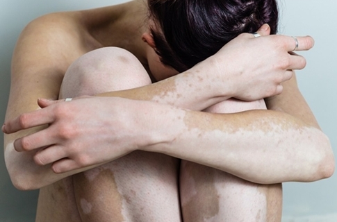 Cara Cepat Menghilangkan Vitiligo dengan Ampuh Cara Cepat Menghilangkan Vitiligo dengan Ampuh
