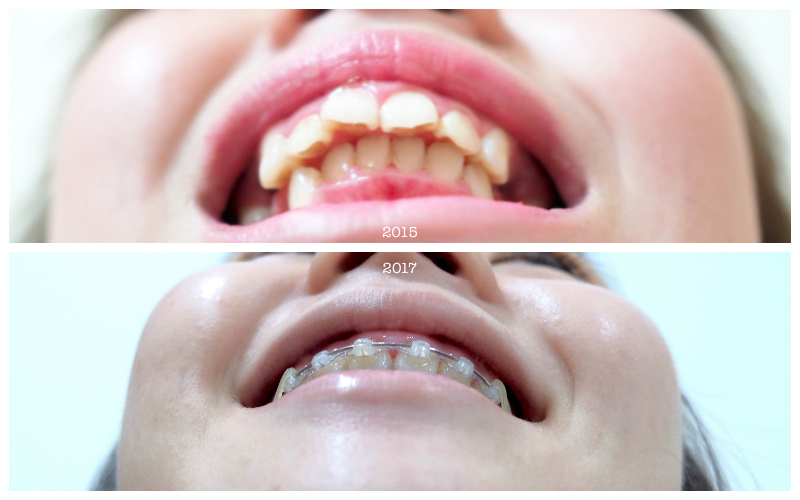 MY BRACES STORY 5 Laser Gum & Changes Travel & Beauty