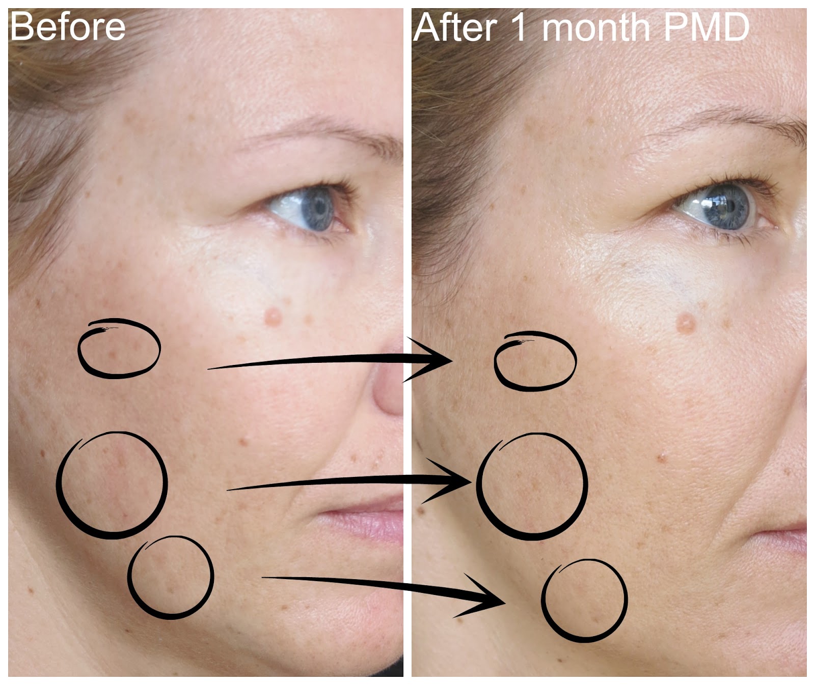 PMD PERSONAL MICRODERM 1 MONTH UPDATE WITH BEFORE AFTER PICTURES!