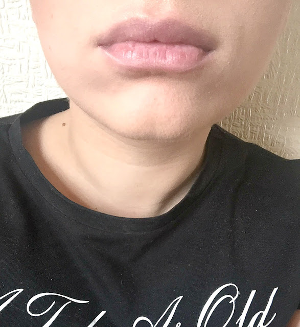 lips after plumping