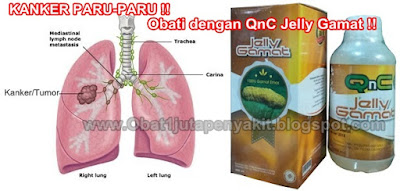 Obat Kanker Paru-Paru Herbal, 100% Terbukti MANJUR Mengobati Kanker Paru-Paru Obat Kanker Paru-Paru Herbal, 100% Terbukti MANJUR Mengobati Kanker Paru-Paru