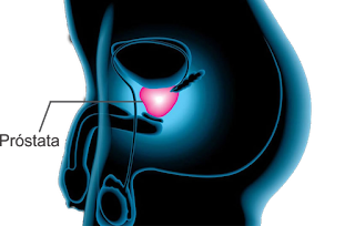 Câncer de próstata aumenta risco de demência através de terapia hormonal, diz estudo