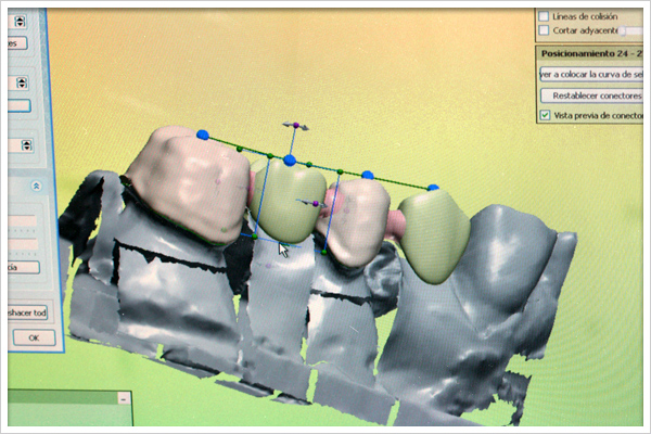 Fabrinovedoso: NUEVAS TECNOLOGIAS APLICADAS EN PROTESIS DENTALES CAD-CAM