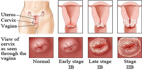 Genital warts in the vagina - Porn tube