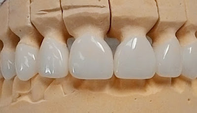  Bọc răng sứ mất bao lâu áp dụng cho răng cửa?