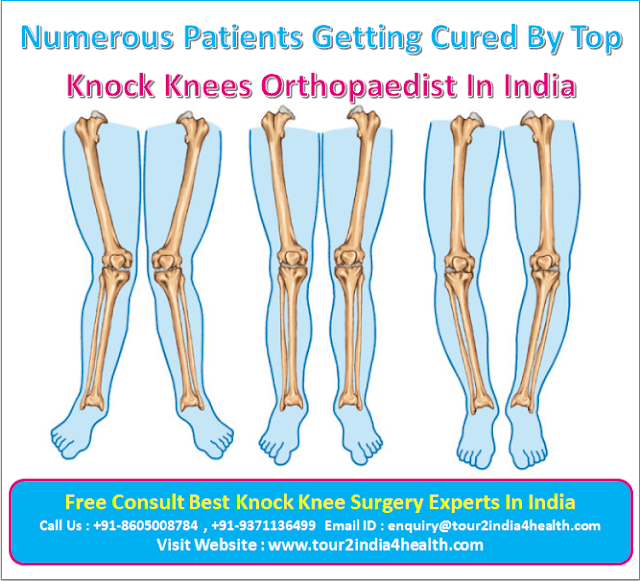 Knock knee surgery cost