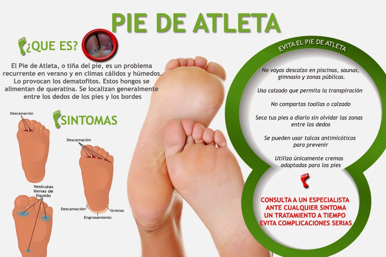 Infografia Pie De Atleta Pie De Atleta Cosas De Enfermeria My XXX Hot