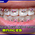 (Gambar) Kesan Buruk Memakai Fake Braces Yang Agak Ngeri