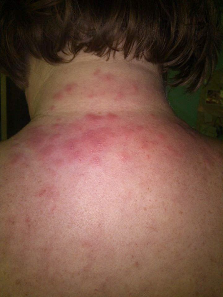 What does lupus rash feel like