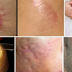 Deep Scars That You Always Wanted To Remove Already Have A Solution