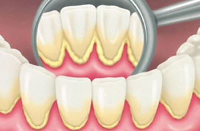 Lấy cao răng hiệu quả như thế nào?