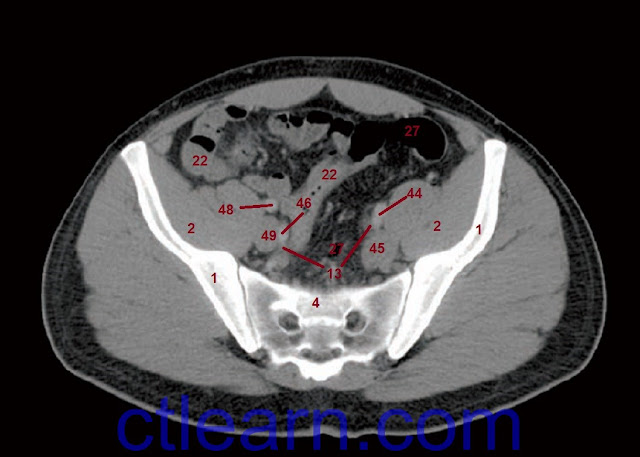Male Abdomen and Pelvis CT Scan