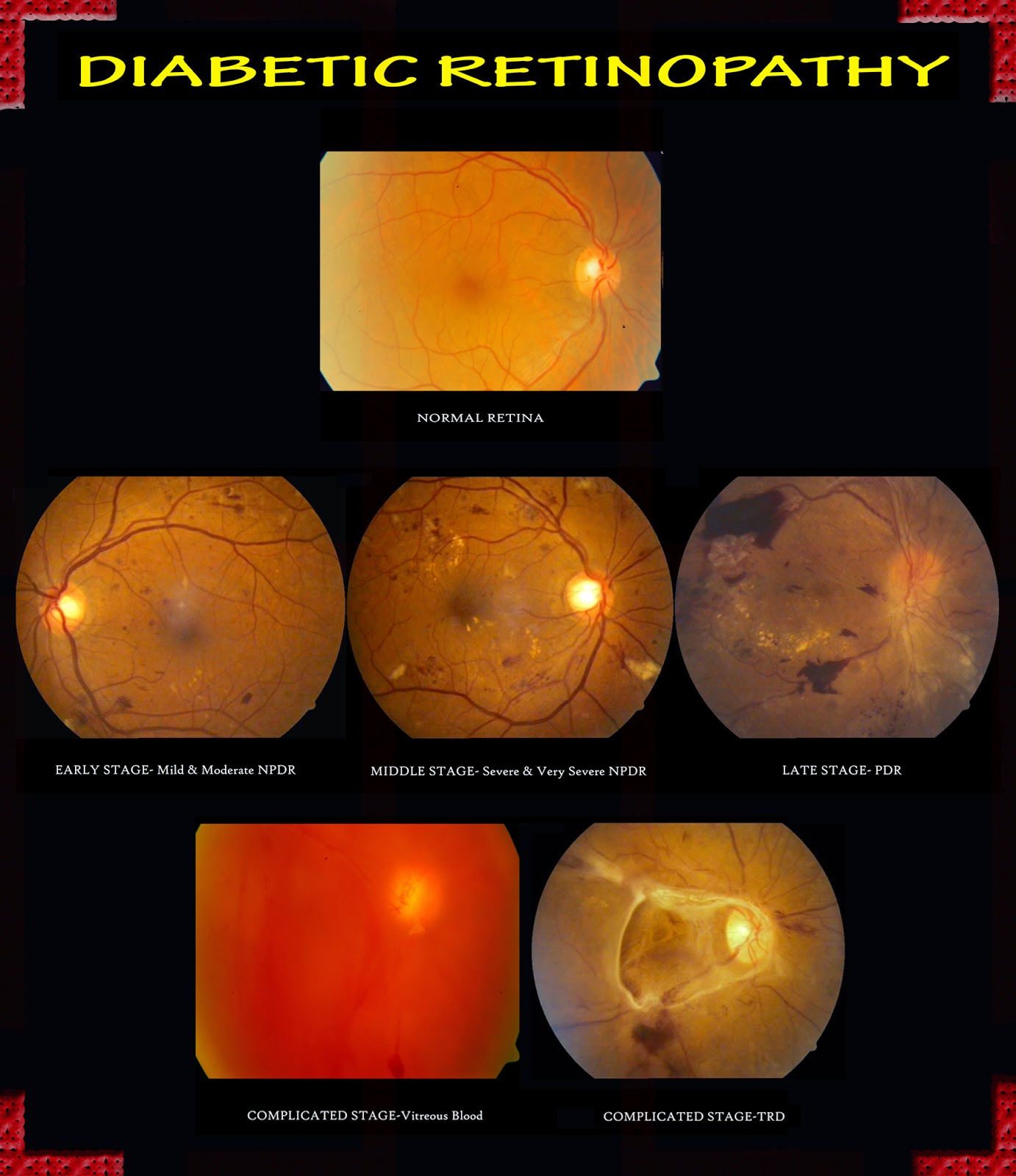 thesis on diabetic retinopathy