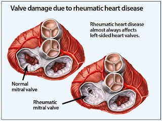 Rheumatic Fever and Heart Disease