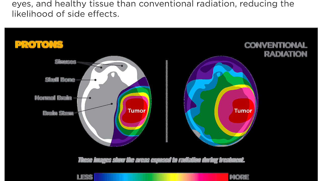 Side Effects Of Whole Brain Radiation Effect Choices