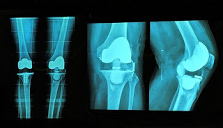 Knee replacement Surgery  in India