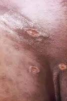 Cara Mengatasi Sipilis Secara Medis Cara Mengatasi Sipilis Secara Medis