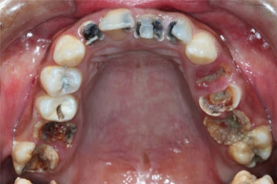 Làm rõ thực hư chuyện sâu răng dẫn đến ung thư-1