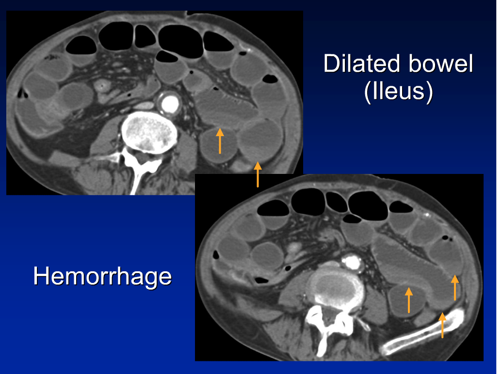 rsna ischemic bowel disease 완전 정리 짱