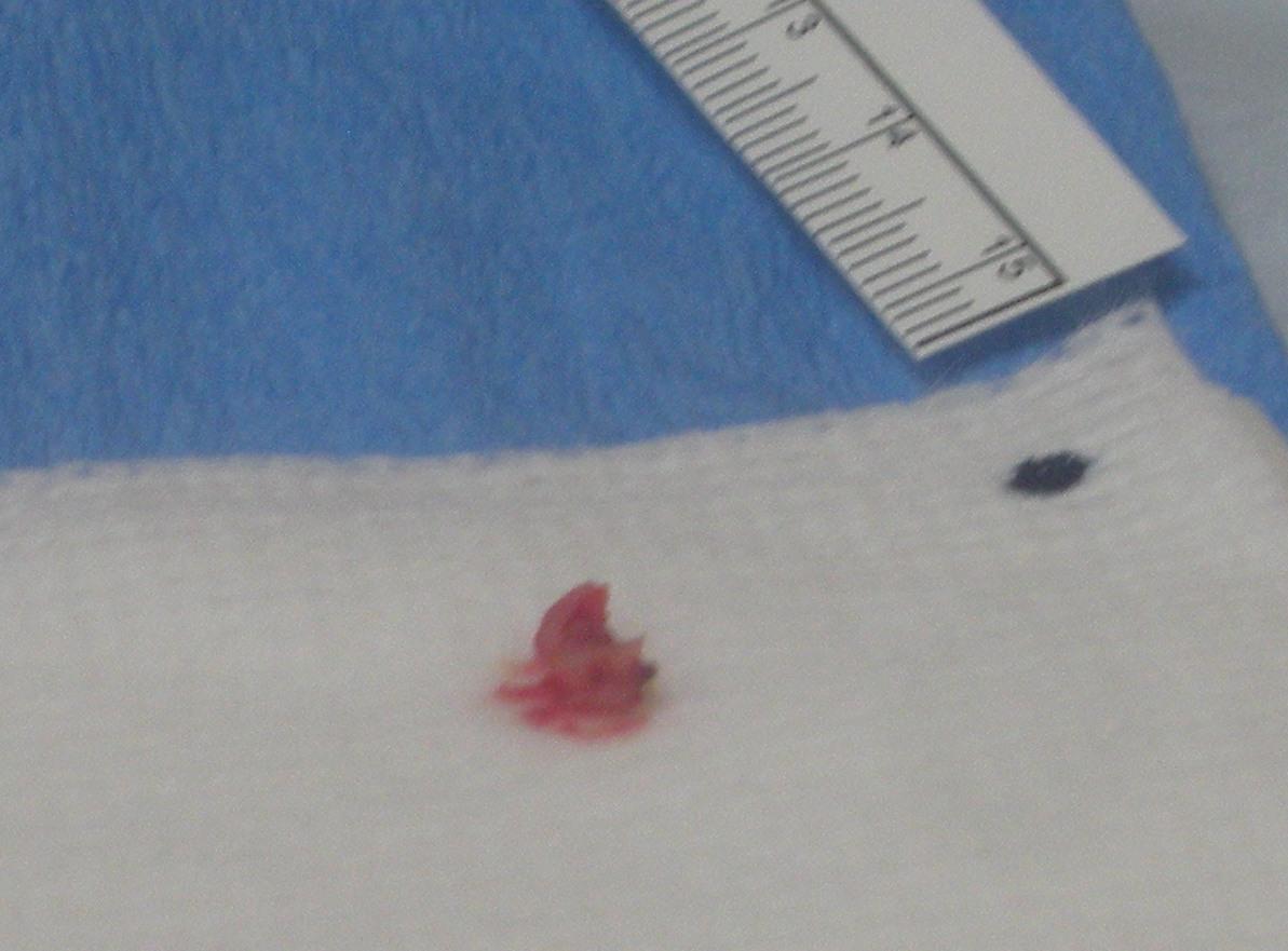 Basal Cell Carcinoma Cancer on My Nose Mohs Surgery Basal Cell