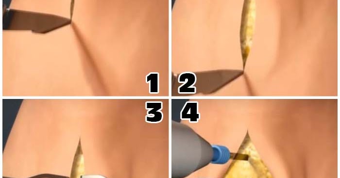 Tracheostomy Procedure | Nurselk.com