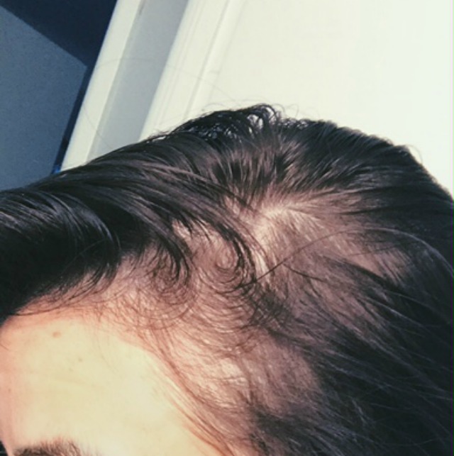 Dealing With Hair Loss Telogen Effluvium Stress Products I Ve