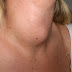 Quels sont les symptômes du cancer de la thyroïde - Types de cancer de la thyroïde.