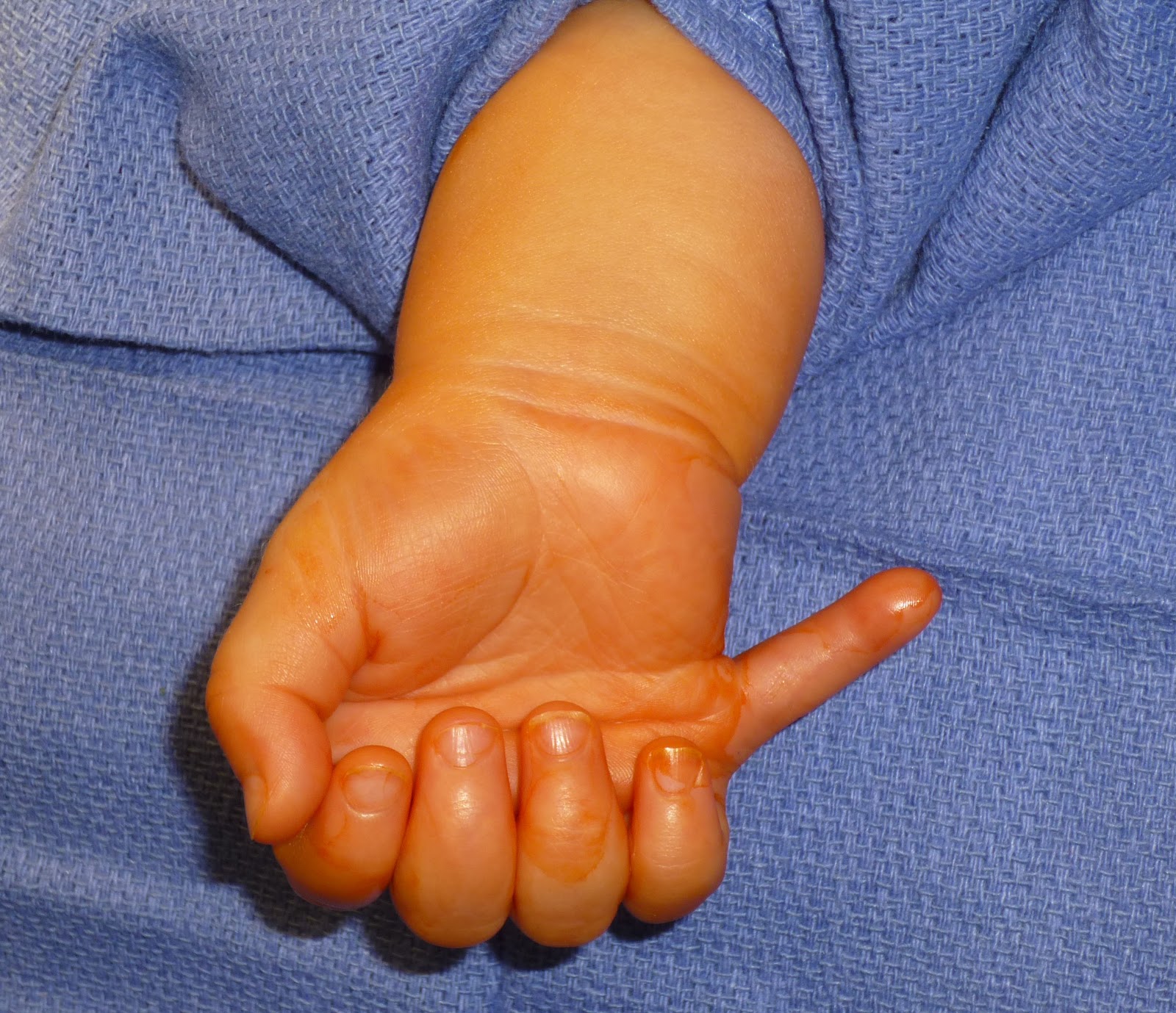 Extra Digits Congenital Hand And Arm Differences Washington 