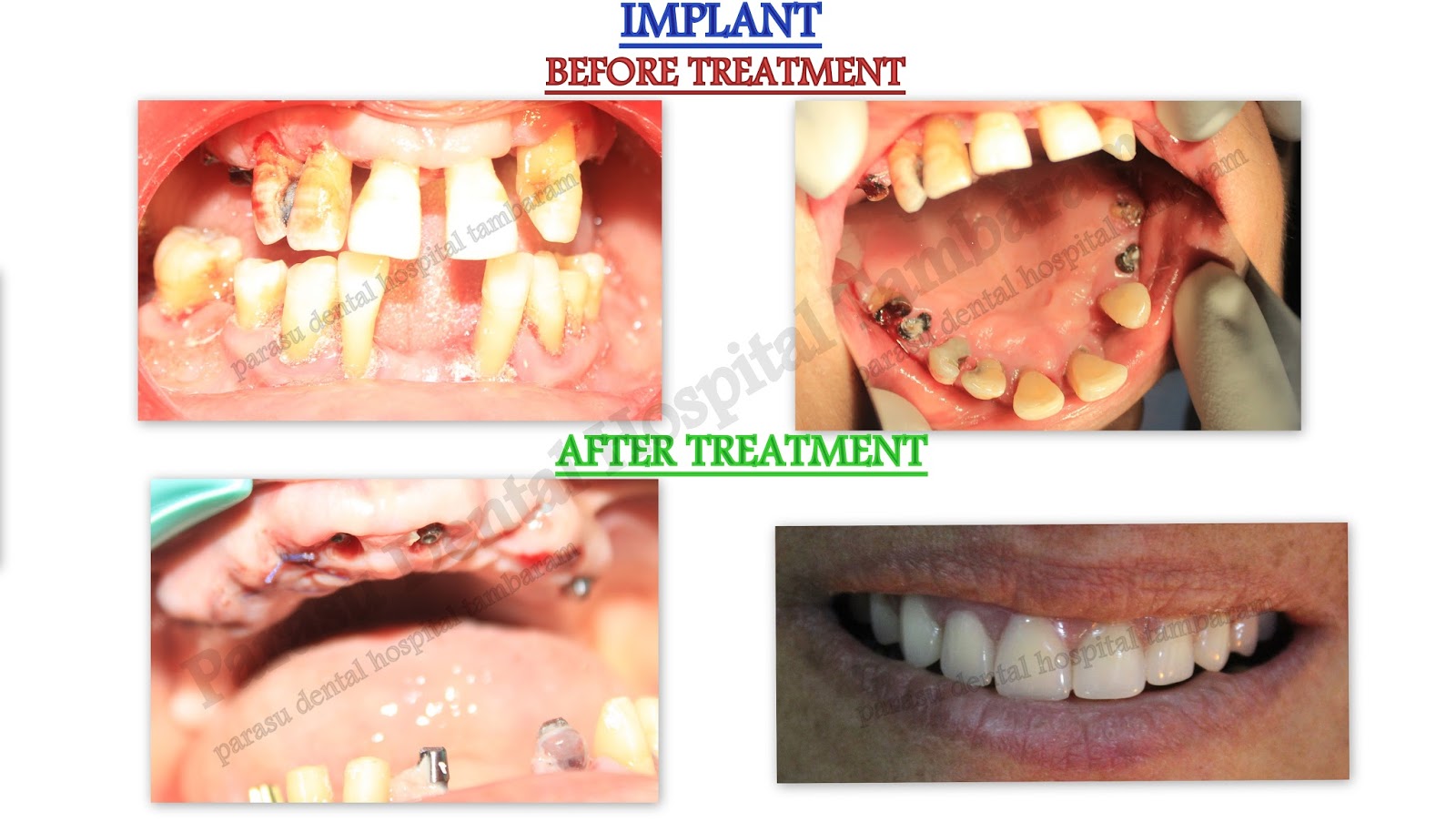 Dental Xray center in medavakkam Nobel biocare dental implants in india