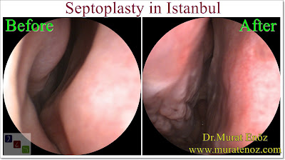 How Much Does a Septoplasty Surgery Cost? - How Much Does a Septoplasty Surgery Cost in Turkey? - Septoplasty Cost in istanbul - Septoplasty Surgery in İstanbul - What Is The Cost Of Septoplasty in Istanbul, Turkey - Septoplasty İstanbul - Deviated Septum Before and After Septoplasty in İstanbul How Much Does a Septoplasty Surgery Cost? - How Much Does a Septoplasty Surgery Cost in Turkey? - Septoplasty Cost in istanbul - Septoplasty Surgery in İstanbul - What Is The Cost Of Septoplasty in Istanbul, Turkey - Septoplasty İstanbul - Deviated Septum Before and After Septoplasty in İstanbul