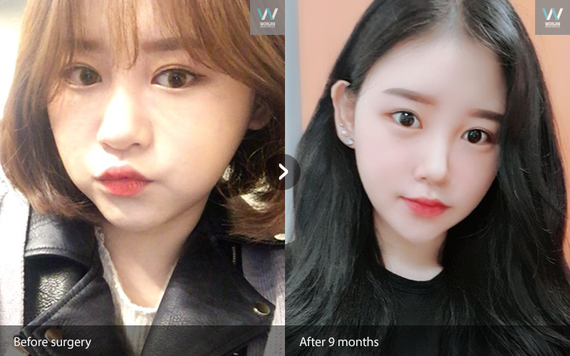 [Real Diary] Korean Face Contouring And Buccal Fat Removal Makes My