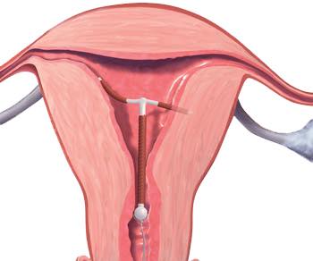 bayi baru lahir pegang alat perancang keluarga iucd
